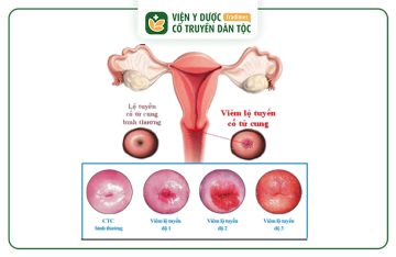 Viêm Lộ Tuyến 1cm Là Độ Mấy? Có Nguy Hiểm Không?