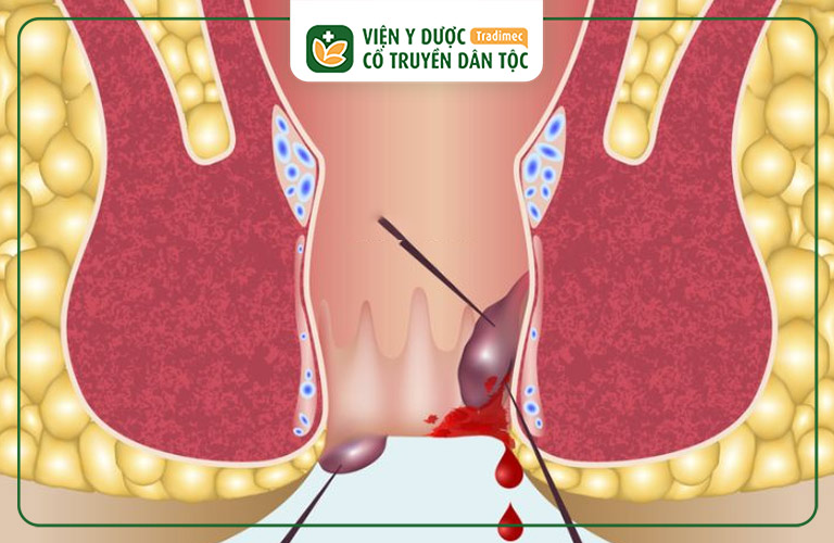 Bị lồi thịt đau rát có thể là dấu hiệu của ung thư hậu môn