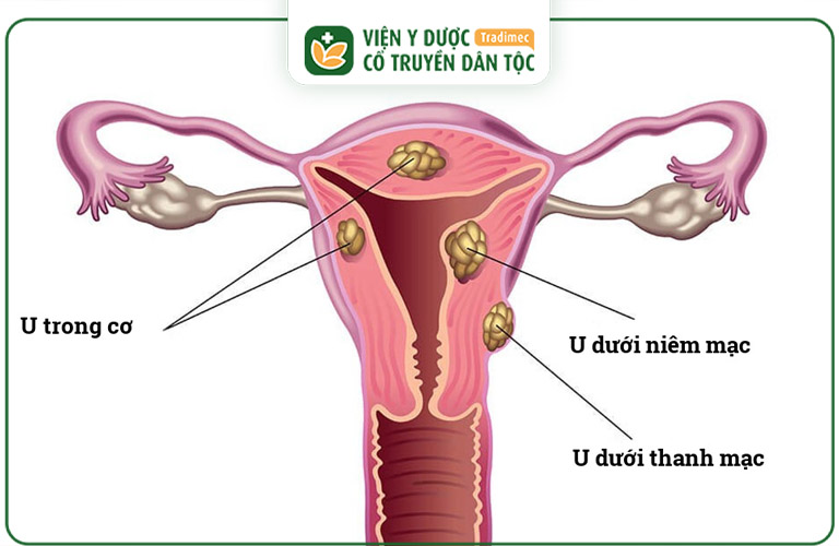 U xơ tử cung là các khối u lành tính phát triển từ cơ tử cung