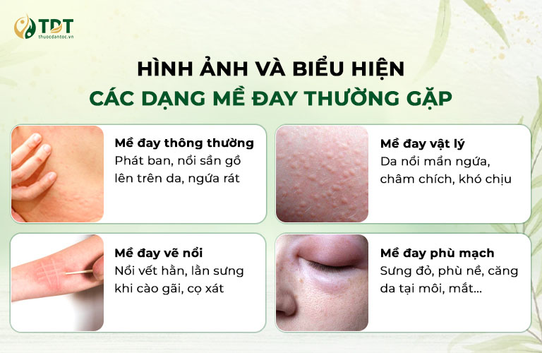 Hình ảnh biểu hiện nổi mề đay