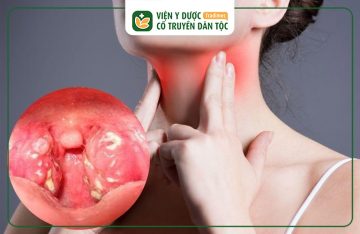 Viêm Amidan Mãn Tính Có Gây Ung Thư Không? Cách Ngăn Ngừa