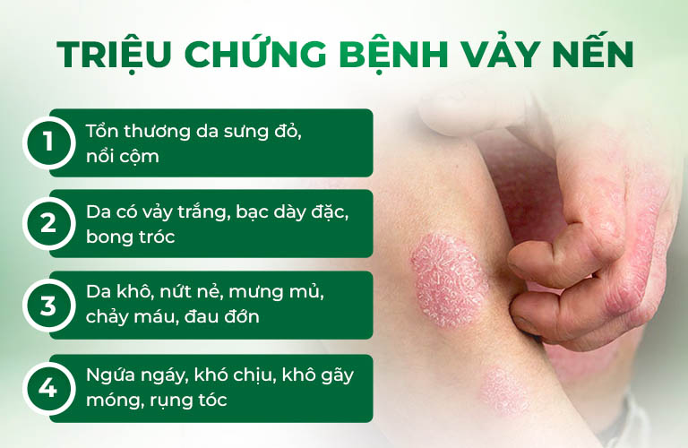 Triệu chứng bệnh vảy nến