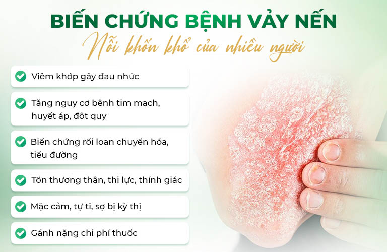 Vảy nến ảnh hưởng lớn đến chất lượng cuộc sống người bệnh