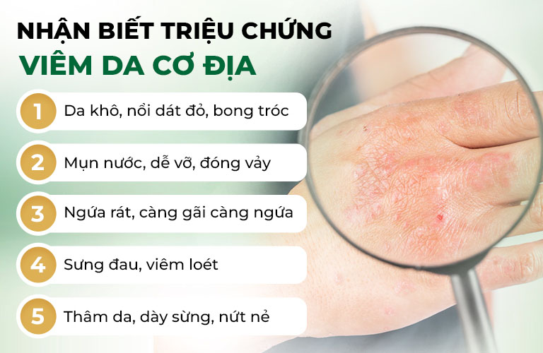 Triệu chứng viêm da cơ địa