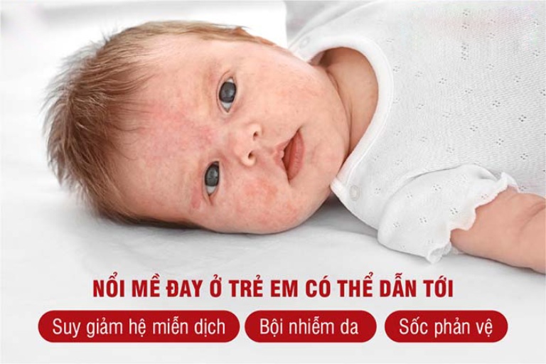 Nổi mề đay ở trẻ có thể gây biến chứng nguy hiểm